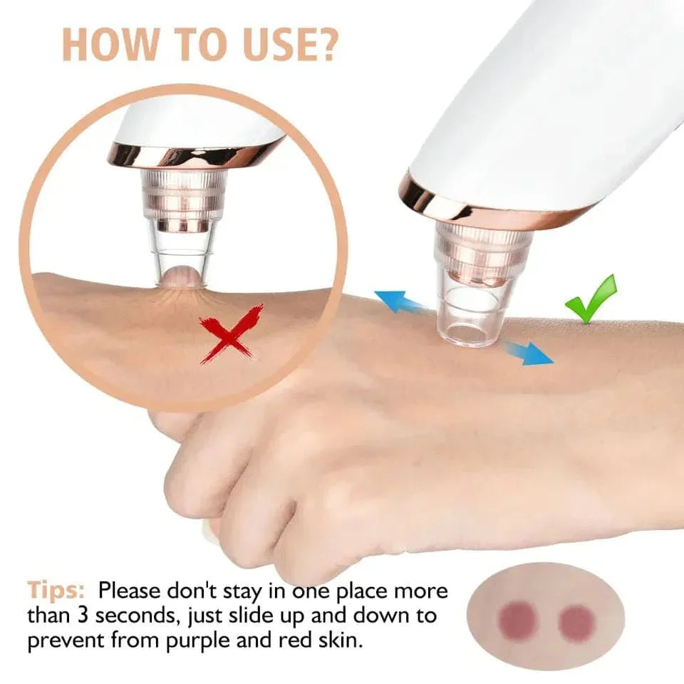 Electric Blackhead Remover, Vacuum Acne Cleaner Removal Device